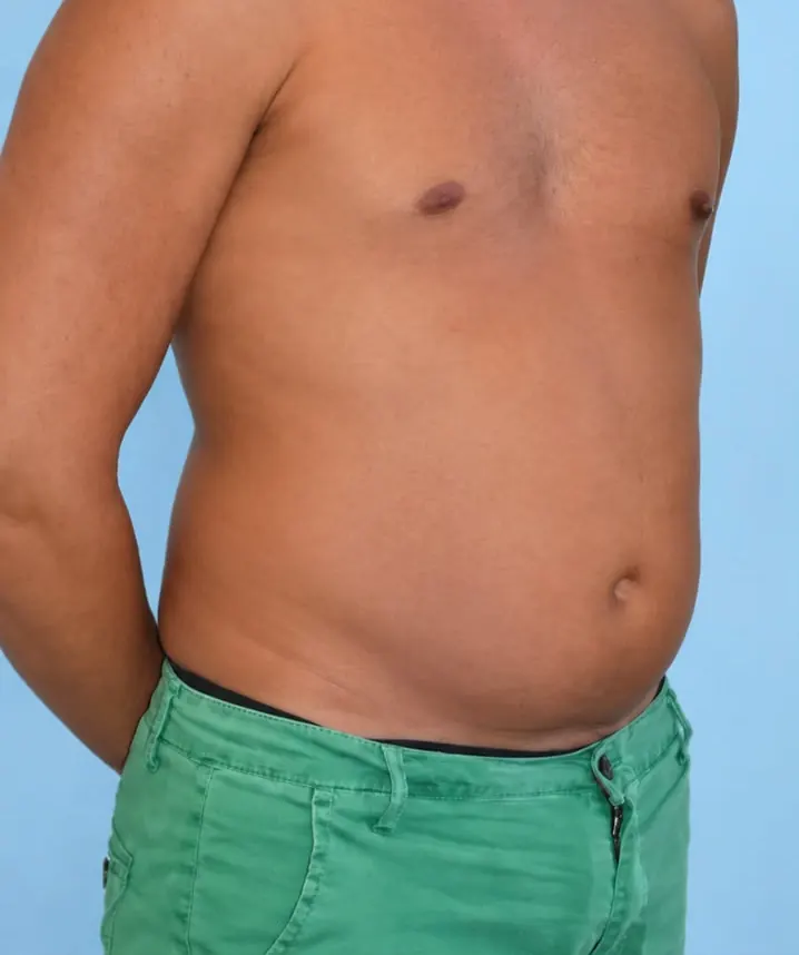 Torso y abdomen: antes del procedimiento